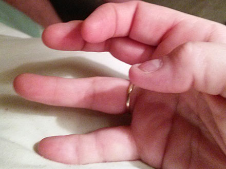 Patient with spasticity
